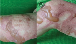 Severe burn, initial condition