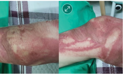 Severe burn, blisters deflated