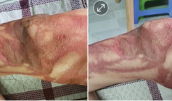 Severe burn, blisters dried and peeling