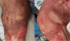 Severe burn, inner layer peeling and new skin revealed