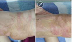 Severe burn, leg completely healed