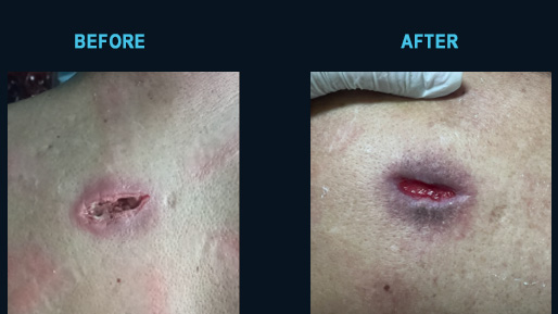 Back abscess progressing day one to day sixteen