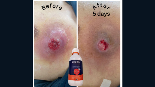 Sebaceous cyst abscess before and after five days
