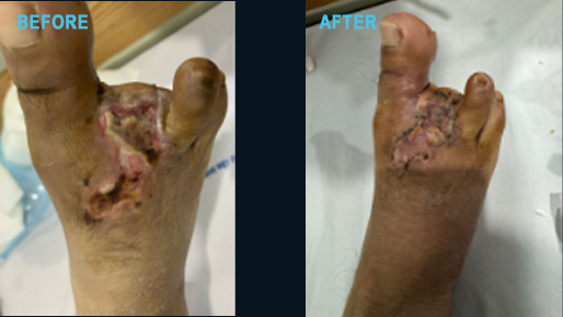 Diabetic foot wound progressing through post-graft days
