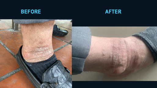 Chronic eczema on the ankle before and after five days