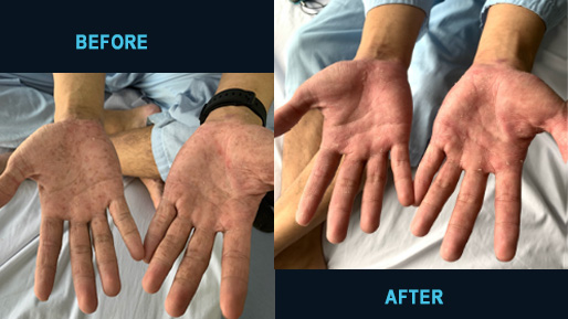 Superinfected dermatitis on the hands before and after seven days
