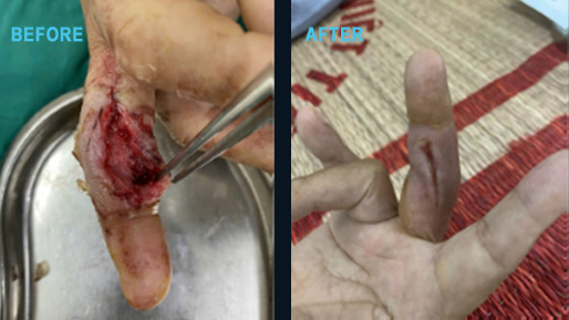 Work-injury finger abscess on day one through to healed at day 23