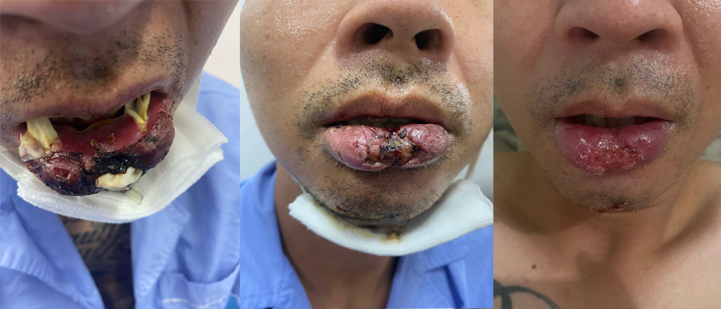 Lip necrosis from abscess healing from day 1 to day 12