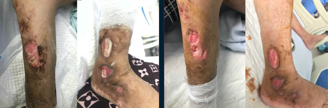 Lower-leg ulcers before treatment and after 15 days of MiraChlor wound care