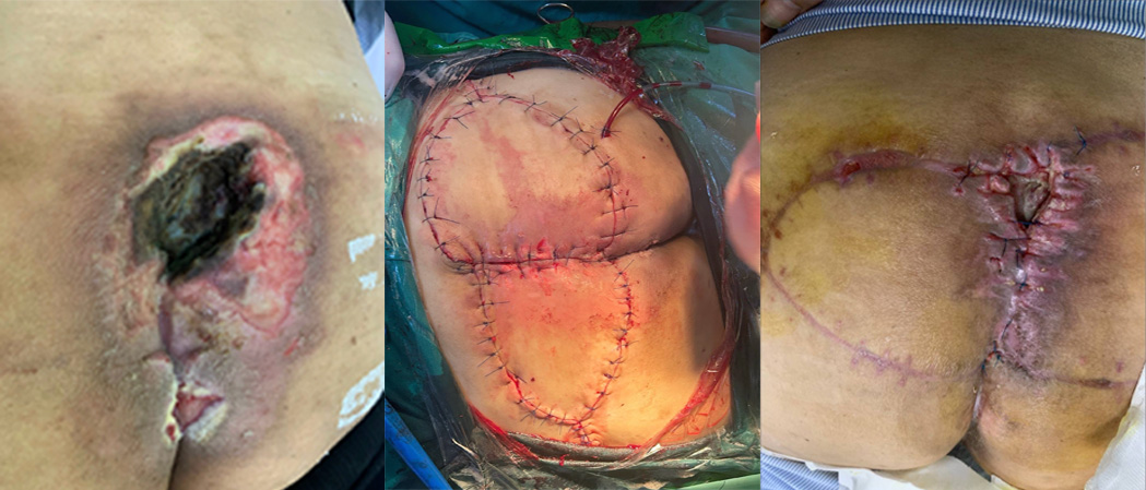 Sacral pressure-ulcer flap reconstruction healing over time