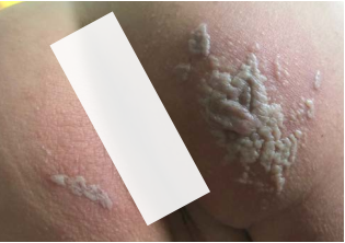 Fire ant bite reaction — raised welts, initial condition