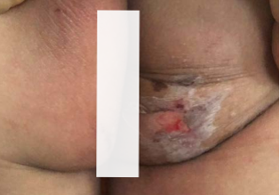 Fire ant bite wound on day two of MiraChlor use