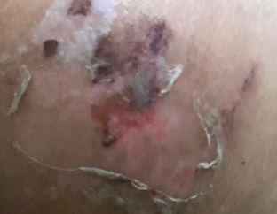Day four — burned skin dried and peeled off