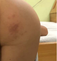 Fully healed skin with only a faint mark remaining