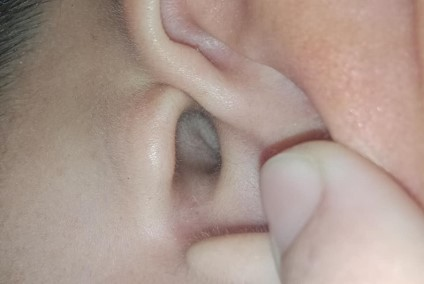 Ear canal checked at home after daily HOCl use