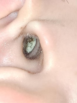 Ear canal with visible white fungal growth before HOCl use