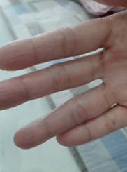 Recovered hand after HOCl use for dyshidrotic eczema