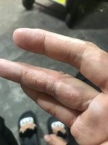 Finger with red, itchy dyshidrotic eczema bumps before HOCl use