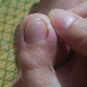 Big toe healed after six days of HOCl soaks