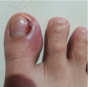 Big toe with swollen, infected paronychia before HOCl use