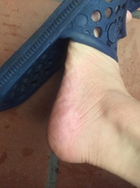 Healed foot in a sandal after two weeks of HOCl use