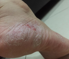 Foot with atopic dermatitis — red, scaling, peeling skin before HOCl use