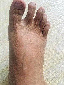 Foot and lower leg with clear skin after five days of HOCl use