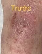 Eczema-affected lower leg with thickened, scaling skin before HOCl use